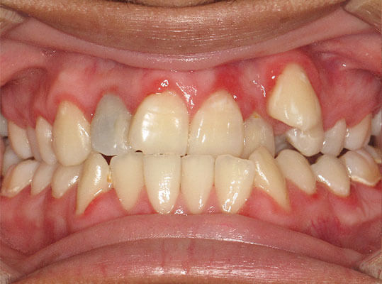 image of a graphic showing teeth before braces
