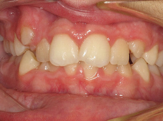 image of a graphic showing teeth before braces
