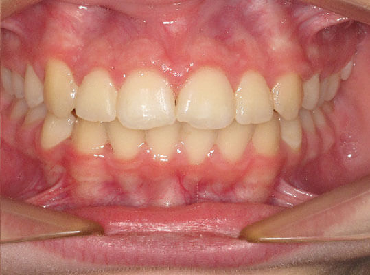 image of a graphic showing teeth after braces