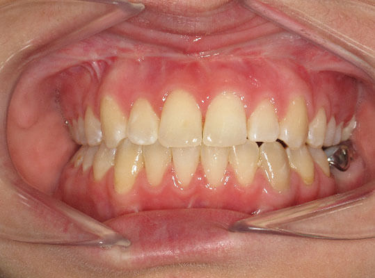 image of a graphic showing teeth after braces